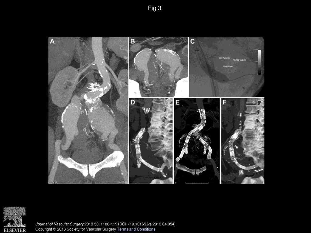 Outcomes of a novel technique of endovascular repair of aneurysmal ...